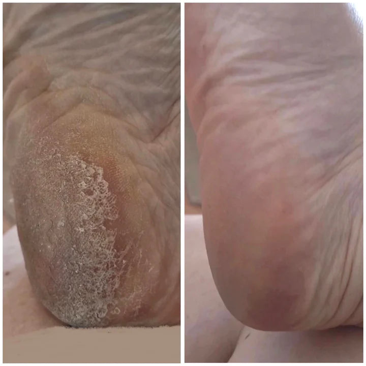Instant Foot Peeling 'The deluxe Kit'