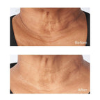 Cold Plasma Plus+ Sub-D Neck