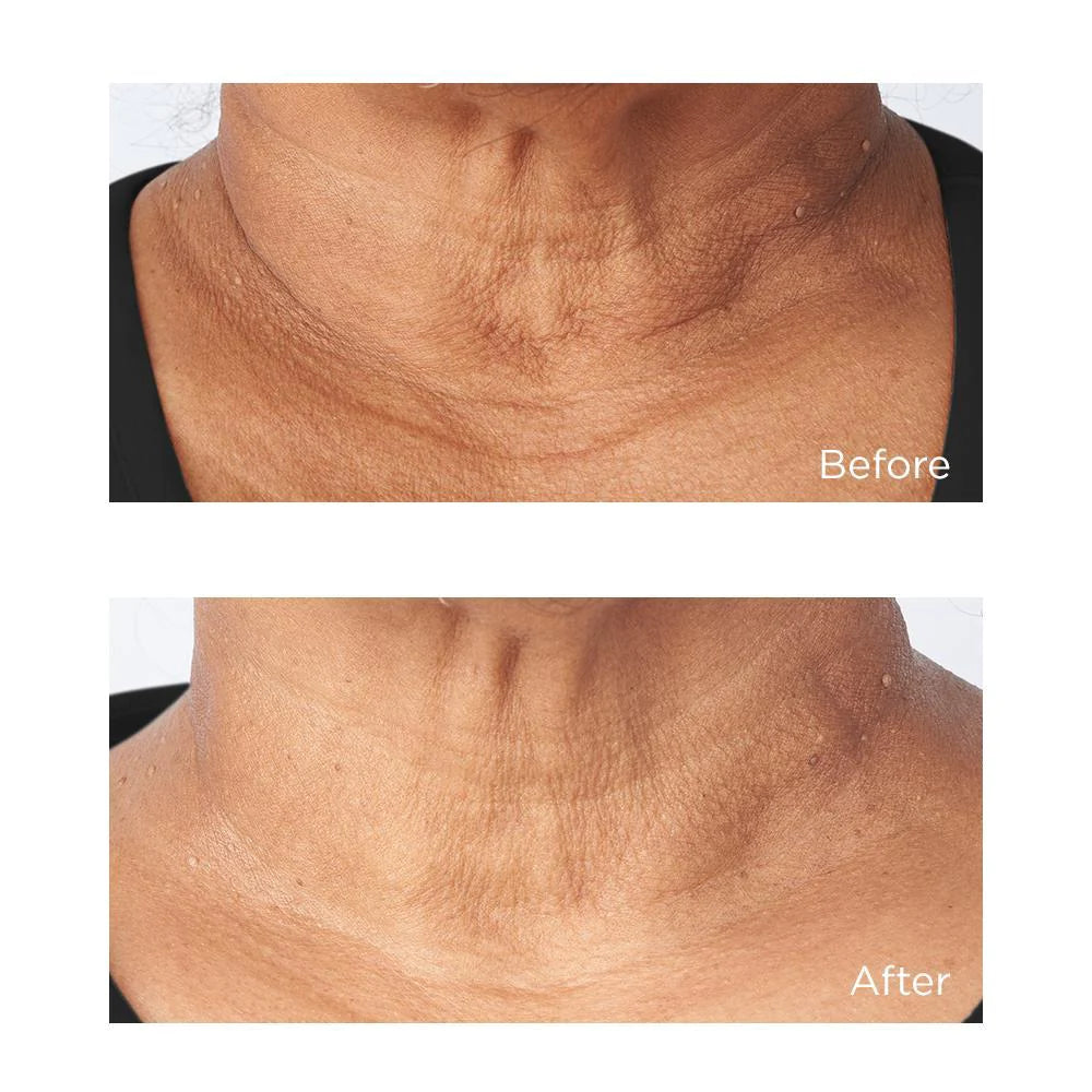 Cold Plasma Plus+ Sub-D Neck