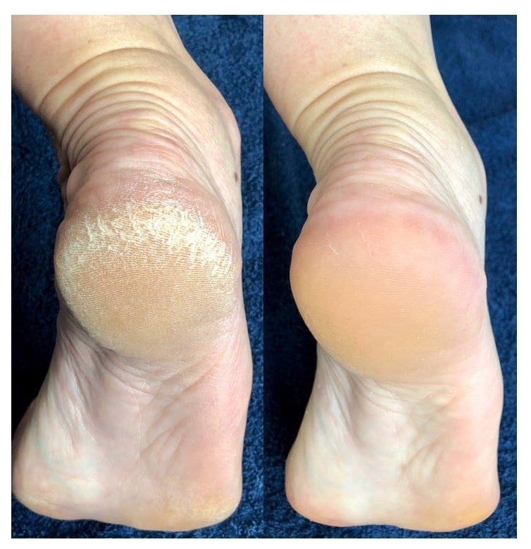 Instant Foot Peeling 'The deluxe Kit'